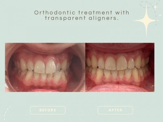 Traitement d'orthododontie avec des aligneurs transparents Invisalign.