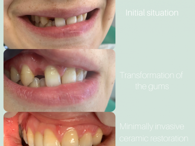 Resin bonded fixed dental prosthesis-missing lateral incisor 